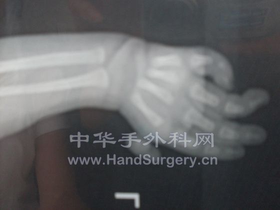 第一掌骨缺损