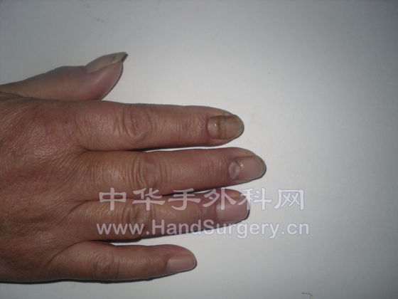没有外伤史，不明原因出现甲板断裂，请教怎么回事？？？