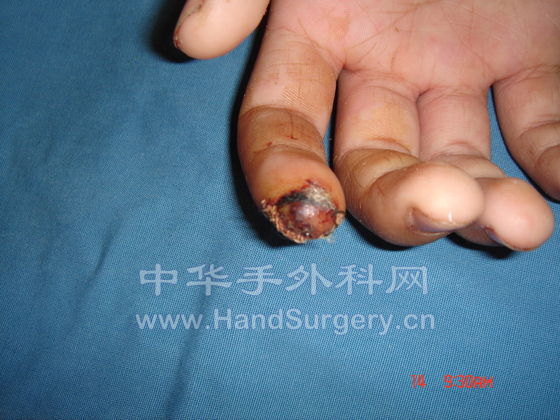 术后第八天01855.JPG