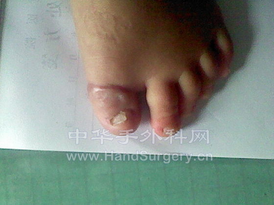 术后半年照片2.jpg