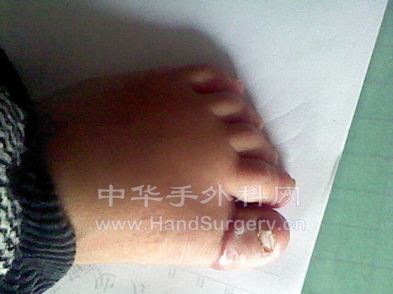 术后半年照片1.jpg