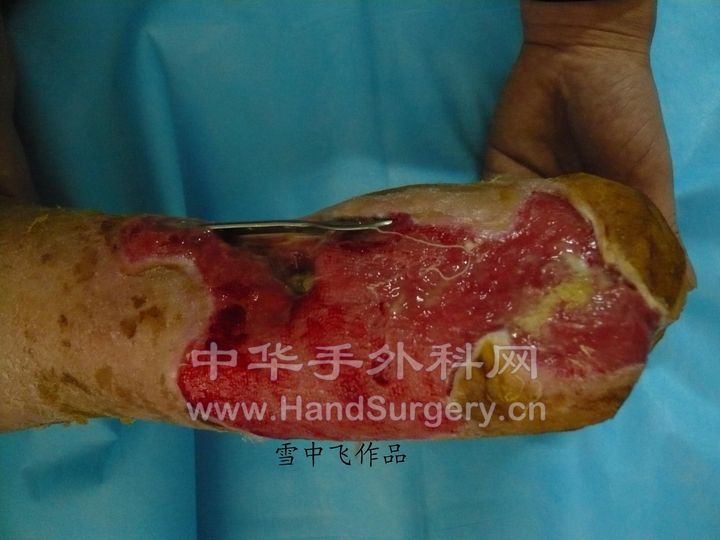 图1，外伤后踝关节外后侧皮肤组织缺损，腓骨钢板及跟骨外露
