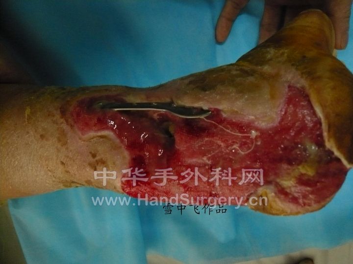 图2，外伤后踝关节外后侧皮肤组织缺损，腓骨钢板及跟骨外露