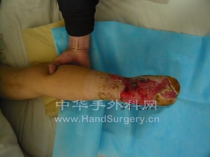 图3，外伤后踝关节外后侧皮肤组织缺损，腓骨钢板及跟骨外露