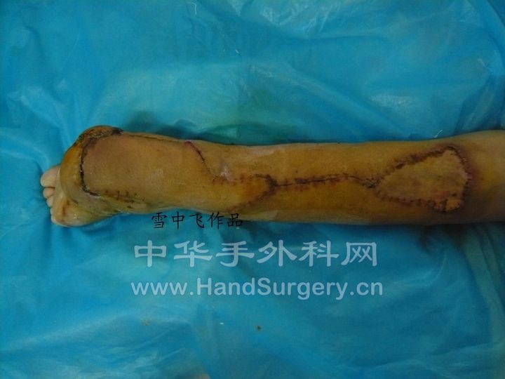 图10，皮瓣痊愈拆线后