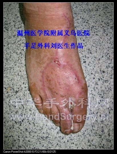 IMG_2558术后供区随访.jpg