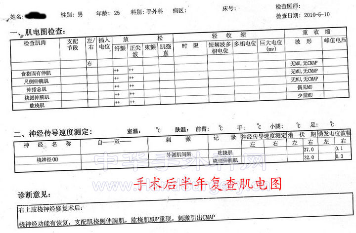 6术后半年肌电图.jpg