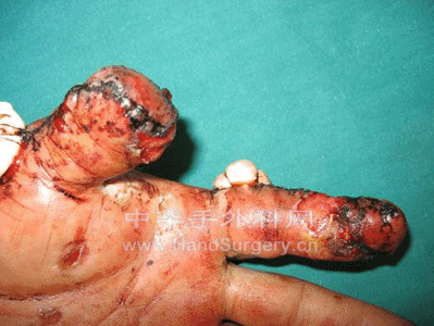 拇指是应用筋膜皮瓣修复指端缺损