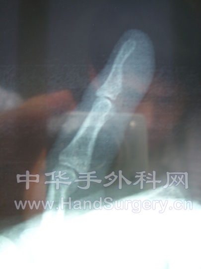 左手指拍片