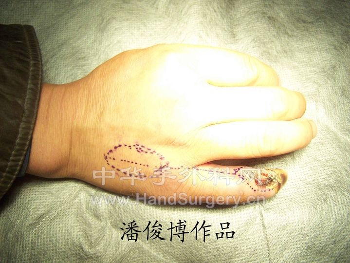 手术设计