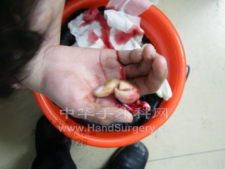右示指被甩干机绞断术前1.JPG