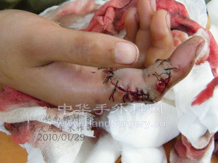 右示指被甩干机绞断术后1.JPG
