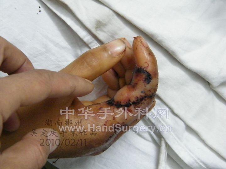 右示指被甩干机绞断拆线后1.JPG