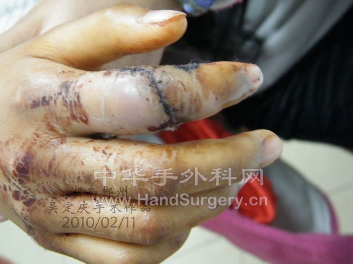 右示指被甩干机绞断拆线后2.JPG