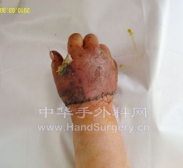 术后第十天.jpg