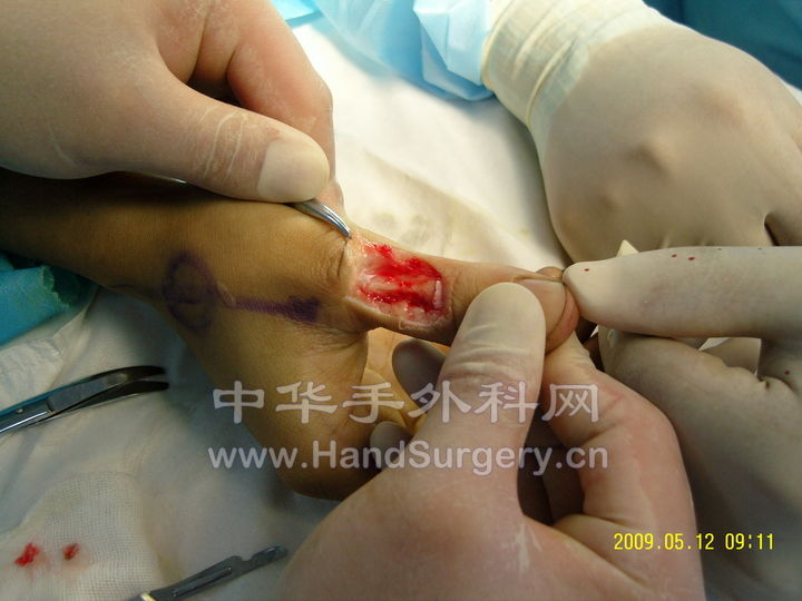 肌腱缺损.jpg