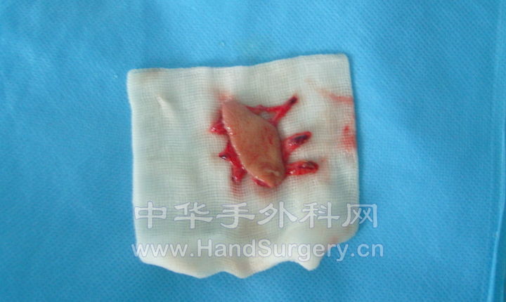静脉皮瓣游离1.jpg