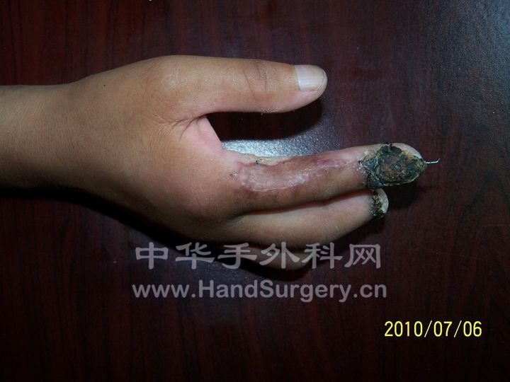 是指桡侧动脉皮瓣