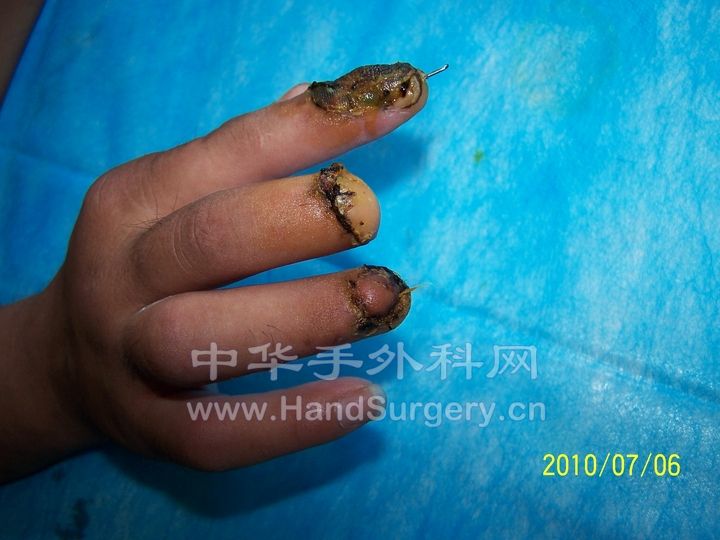 中指反转皮瓣