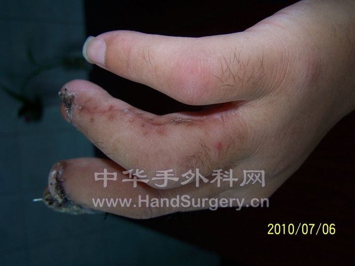 环指  指侧动脉链皮瓣