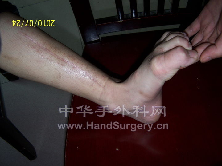 踝部背伸，趾关节不可伸