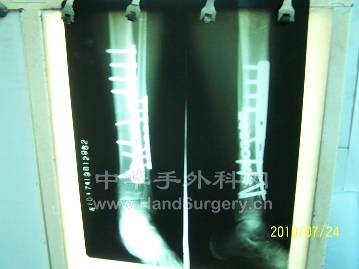 胫腓骨片