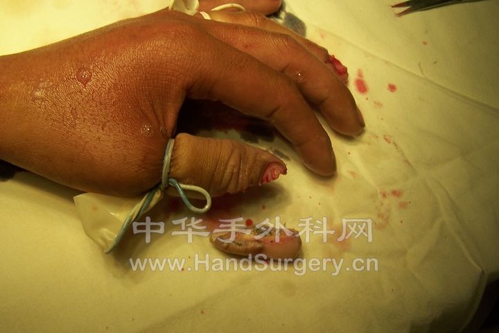 患者在干木工活时，不慎被电锯切割，致左拇指末节完全离断.JPG