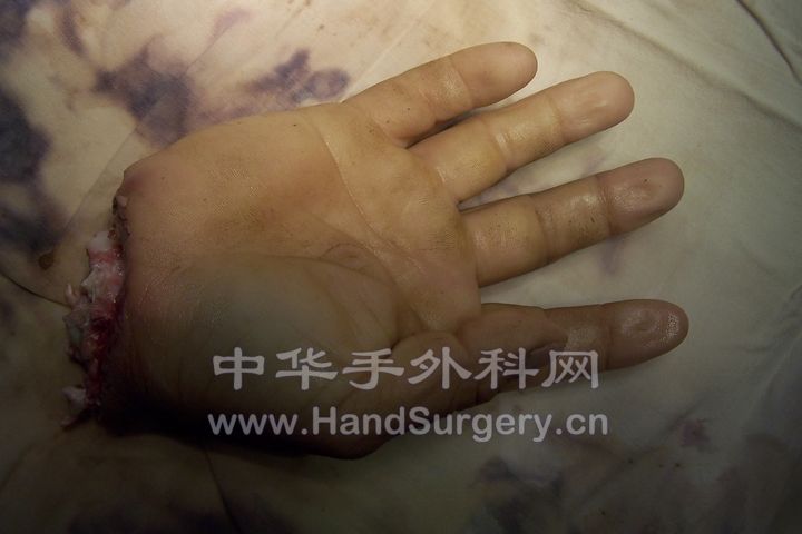 离断肢体掌侧.JPG