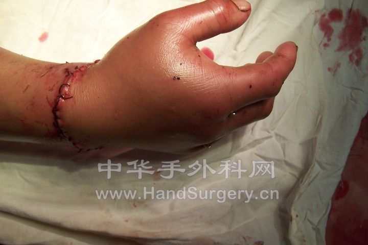 术后照片 (2).JPG
