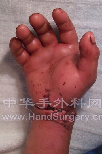 术后一周 (2).JPG