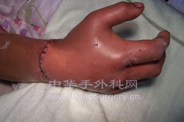 术后一周 (3).JPG