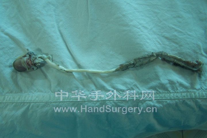 患者在工作中不慎被机器绞伤右手拇指，致右拇指完全离断.JPG