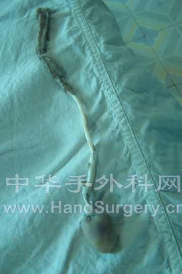 右拇指旋转撕脱离断，肌腱抽出约15公分.JPG