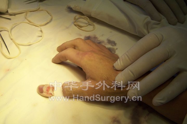 术前背侧.JPG