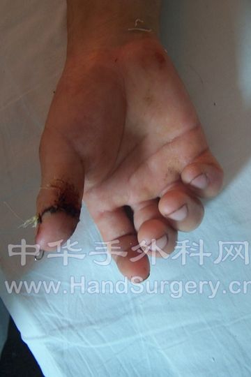 术后十二天.JPG