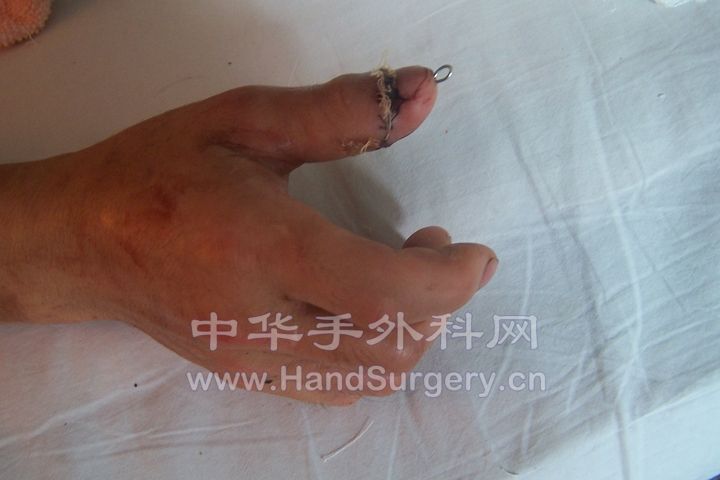 术后十二天 (1).JPG