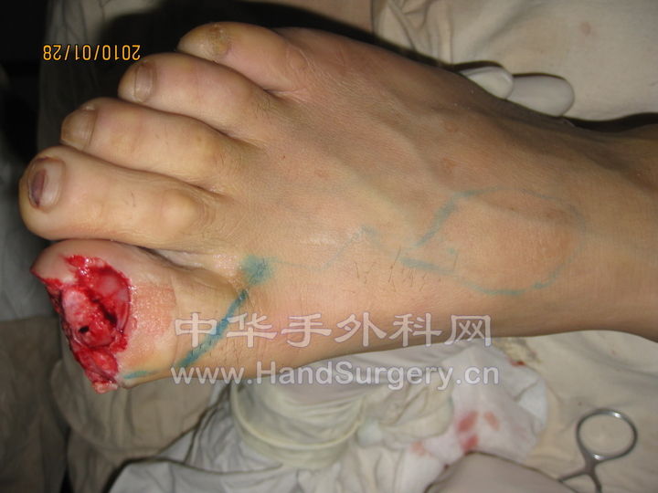 术中设计第一跖背动脉逆行岛状皮瓣.jpg