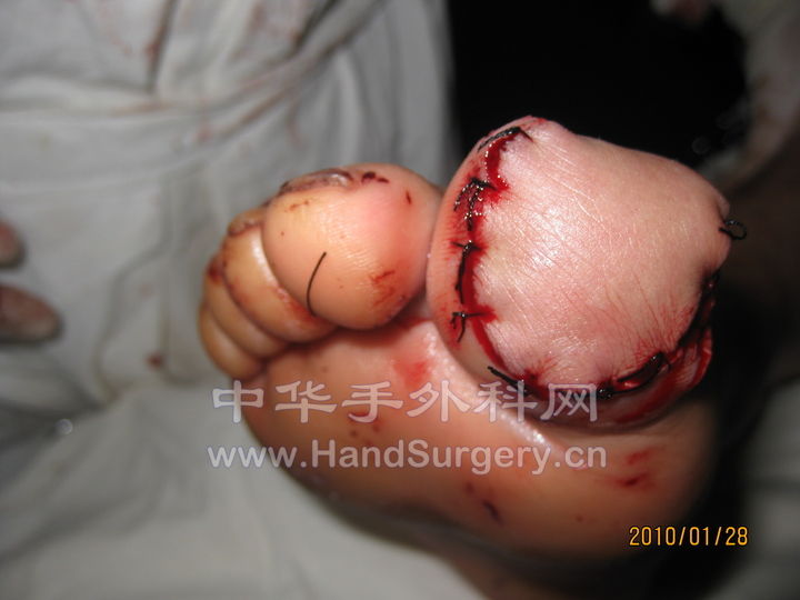 术后照片 (1).jpg
