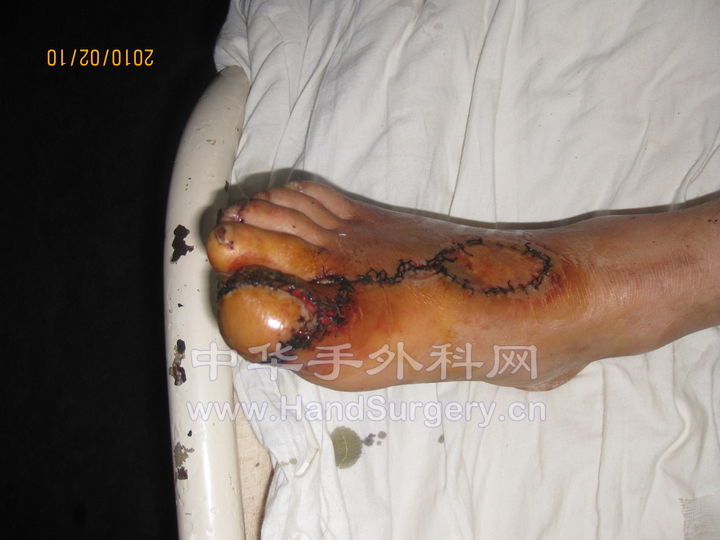 术后十三天 (1).jpg