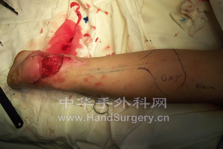 患儿被摩托车轮挤伤右足，致右足跟部皮肤撕脱缺损.JPG