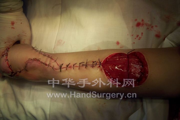 术中设计腓肠神经营养岛状皮瓣.JPG