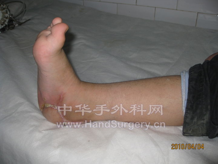 术后两月 (2).jpg