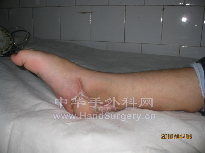 术后两月 (3).jpg