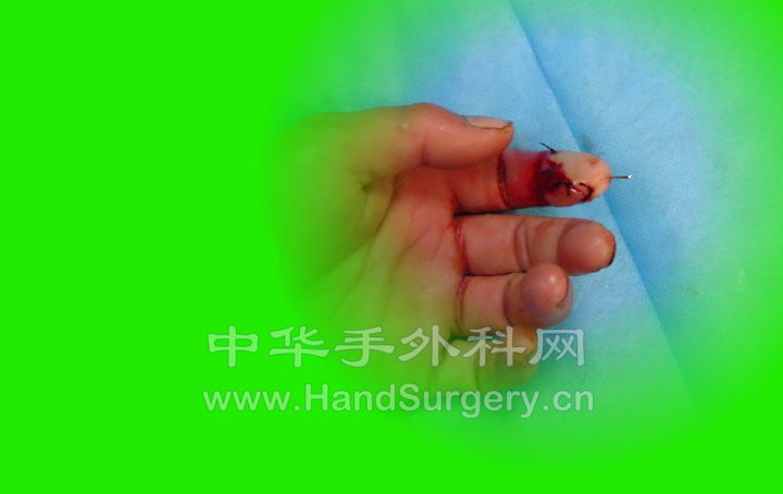 松止血带后.jpg