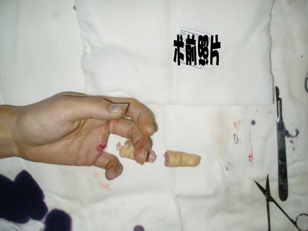 阳黎明术前1_conew1.jpg