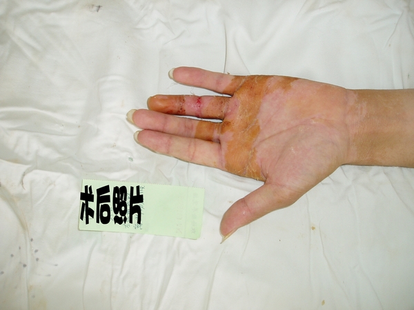 阳黎明术后1_conew1.jpg