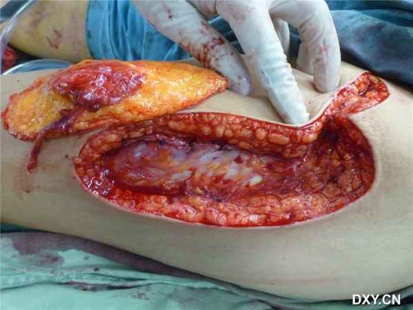 不带阔筋膜，只带了血管入皮点周围部分阔筋膜，保持血运，照片可见供区脂肪非常的厚，皮瓣修薄后脂肪非常的 ...