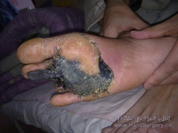 20101015013   前足足底坏死.jpg