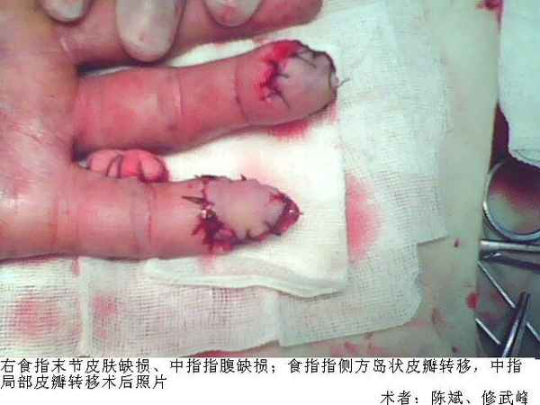术前清创后