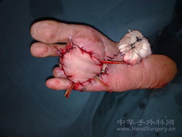 20101022098   皮瓣覆盖后.jpg